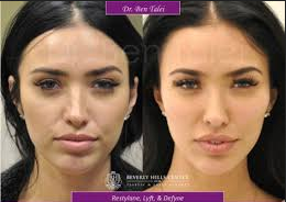 Botox Treatment